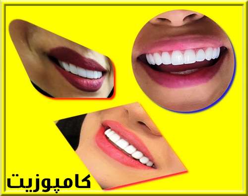 روکش کامپوزیت چیست