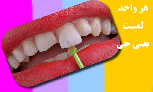 هر واحد لمینت چند دندان است :