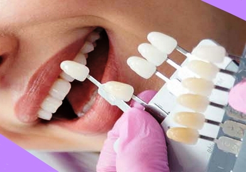 چگونه دندان ها برای لمینت شدن آماده می شود