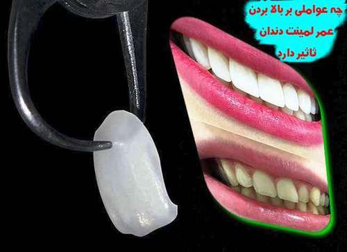 چه عواملی بر بالا بردن عمر لمینت دندان ثاثیر دارد: