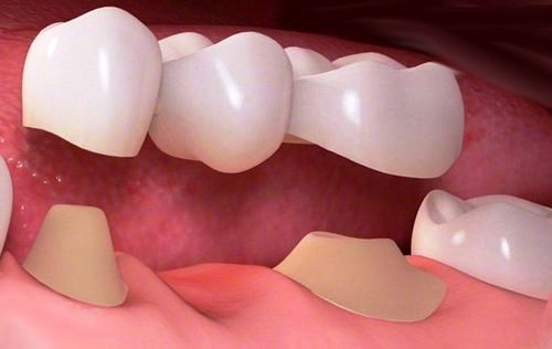 پل دندانی چیست
