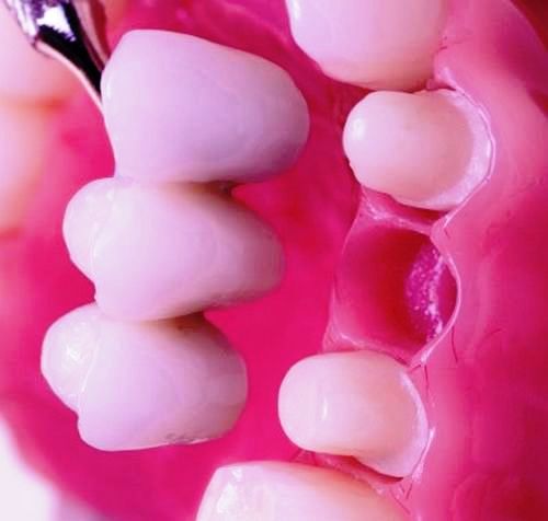 مراحل پل دندانی چگونه است