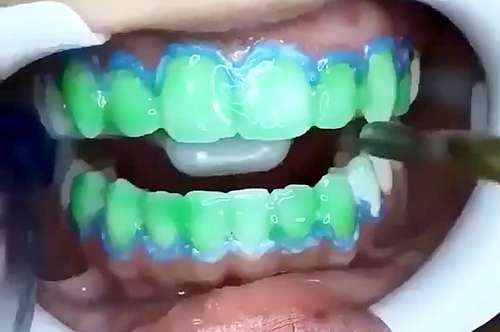 بلیچینگ برای زیبایی دندان